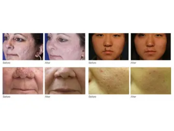 Fractional CO2 Laser System (Skin Resurfacing)