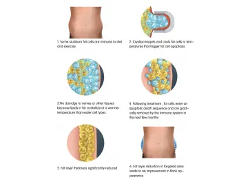 Cryolipolysis