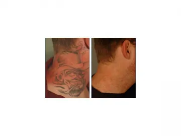 Laser Tattoo Removal and Skin Pigment Treatment Machine